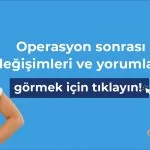 beforeafter-icin-tiklayiniz-1920-px-150×150.jpg Anatomica Klinik