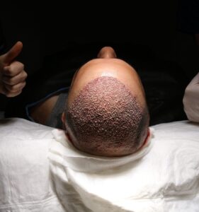 Hair,Transplant,Patient,In,The,End,Of,The,Operation